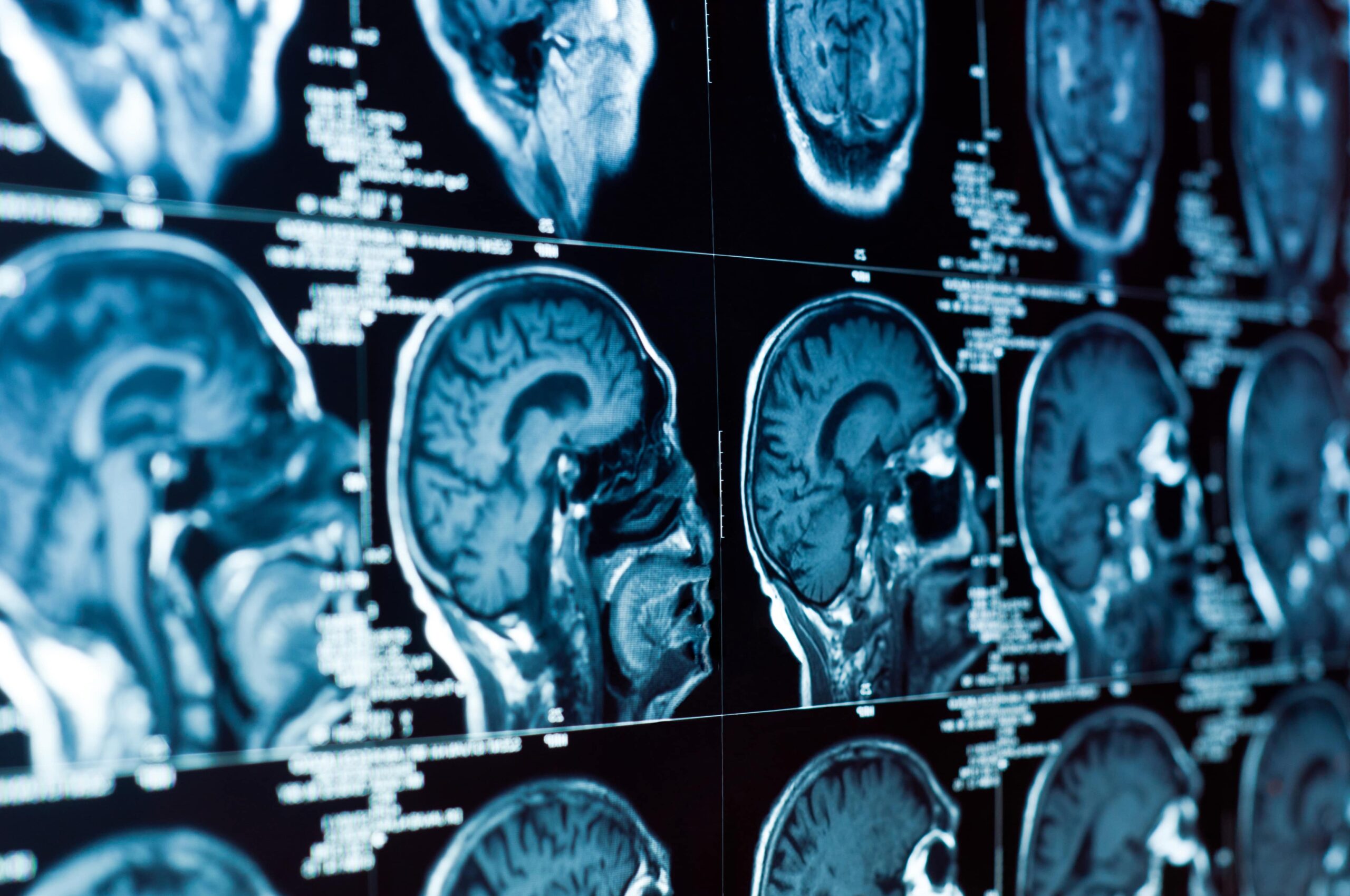 TBI lawyer in Fayetteville, NC